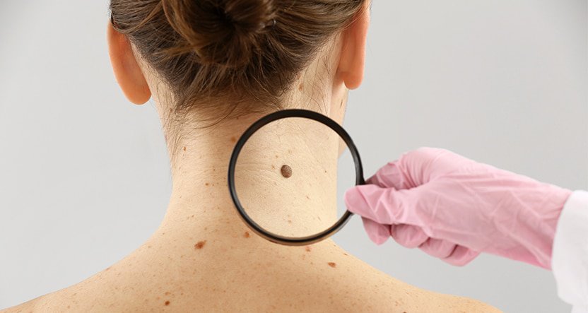 How Often Do I Need to Get a Skin Cancer Screening?